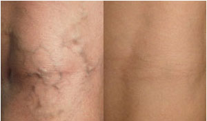 Sclerotherapy