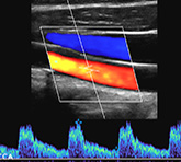 Vascular Duplex